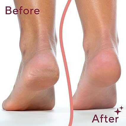 Callus Remover for Feet